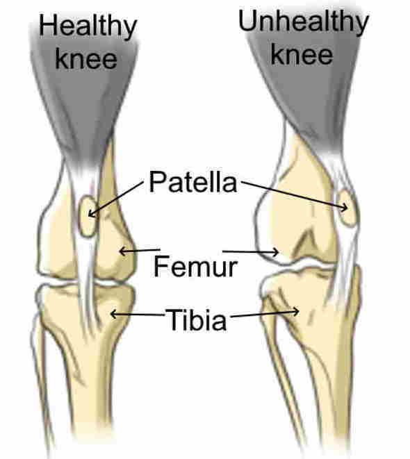 drawing of a healthy knee and one with patella luxation