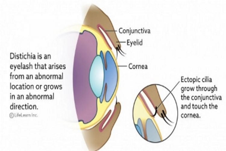 Distichia is an eyelash that grows abnormally which rubs against the eye of the Shih Tzu and causes irritations. Diagram of the eye showing how the abnormal eyelash rubs against the eye.